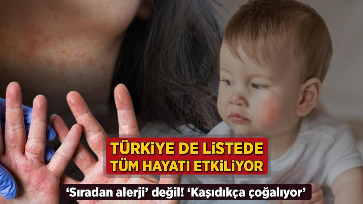 turkiye de listede tum hayati kotu etkiliyor siradan alerji degil kasidikca cogalir lMQHEIDU.jpg